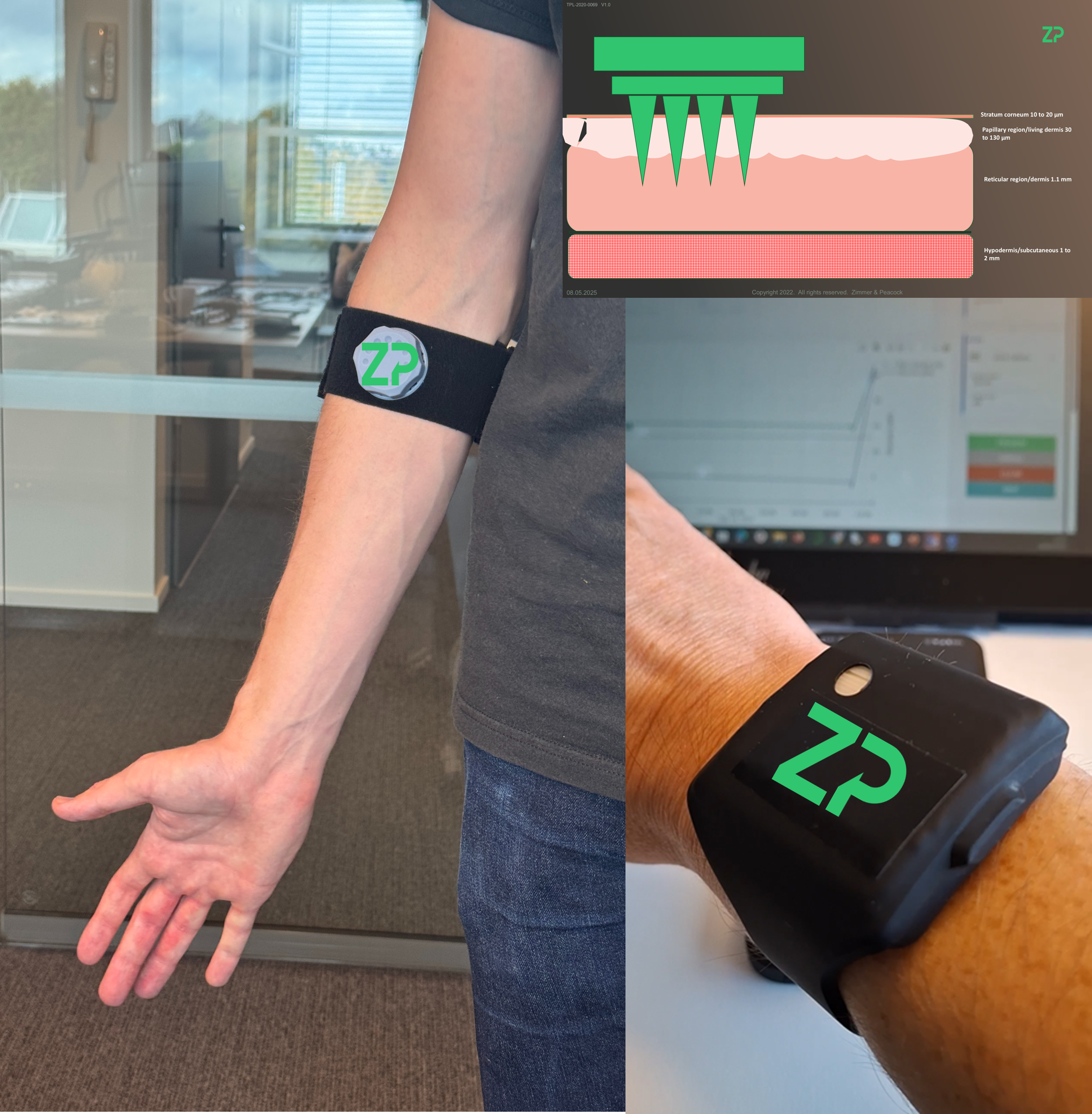 Wearable microneedle biosensors